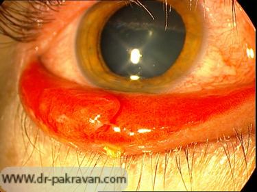 قرمزی چشم همراه با ترشحات چرکی و زرد رنگ در كونژنكتيويت باکتریال